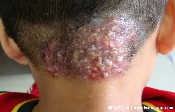 毛囊炎的症状和图片,早期特征和痘痘十分类似(脓包越长越大) — 神奇