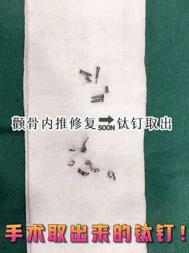 颧骨内推修复,钛钉钛板取出现场