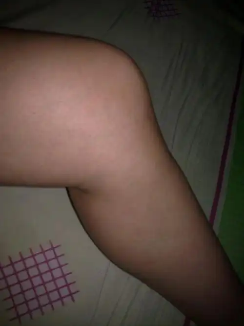 主要症状等):路走多了之后膝盖里面会疼,但能够弯曲,也能蹲下起立