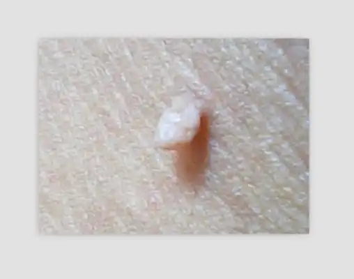 腋下长小肉粒图片5