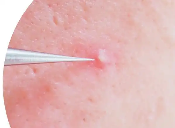 粉刺针怎么去黑头 这些祛黑头方法分享