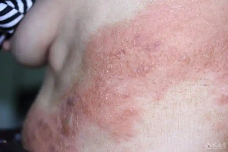 70岁老年妇女带状疱疹无痛一例 - 皮肤及性传播疾病讨论版 - 爱爱医