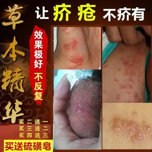 去除疥疮结节霜硫磺软膏疥虱康宁疥虫阴囊疥疮灵皮肤瘙痒疥疮膏