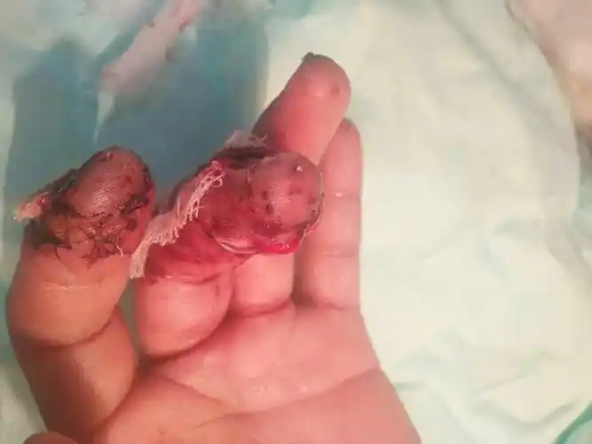 剁排骨不慎砍掉2根手指之--- -断指再植篇( 高精尖)