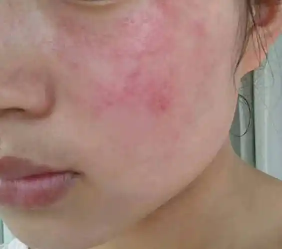皮肤泛红太烦人别急别急教你一招解决