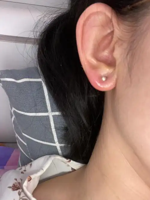 打耳洞一周突然肿了,根本摘不下来