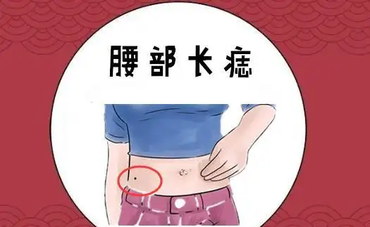 腰部长痣在相学当中,若是在腰部的位置处长有吉痣,则会有"腰缠万贯"的