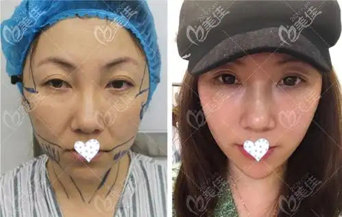 郑州脸部小切口拉皮手术医院中这两家技术很硬天后和广运