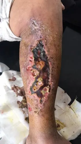 外伤清创缝合术后皮肤坏死.