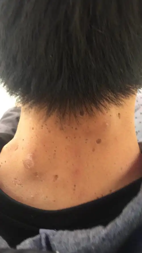 全是很大的洞,还有很大的包,超级恶心,感觉里面烂了这到底是什么病症