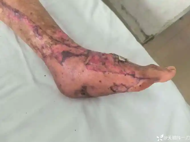 足的皮肤坏死--植皮-康复锻炼.