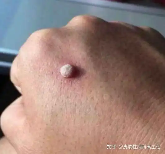 但是手上的瘊子传染到生殖器部位也是瘊子,不是尖锐湿疣.