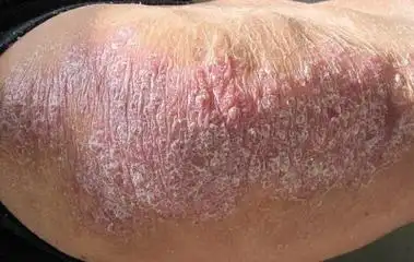 头部银皮屑的症状图片_银屑病求医网