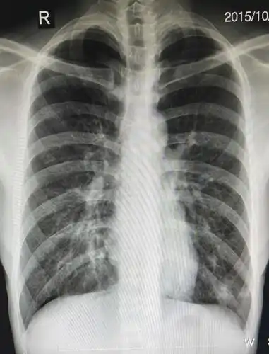 其它 秋冬季节小儿支气管炎了解 写美篇 什么是支气管肺炎呢?