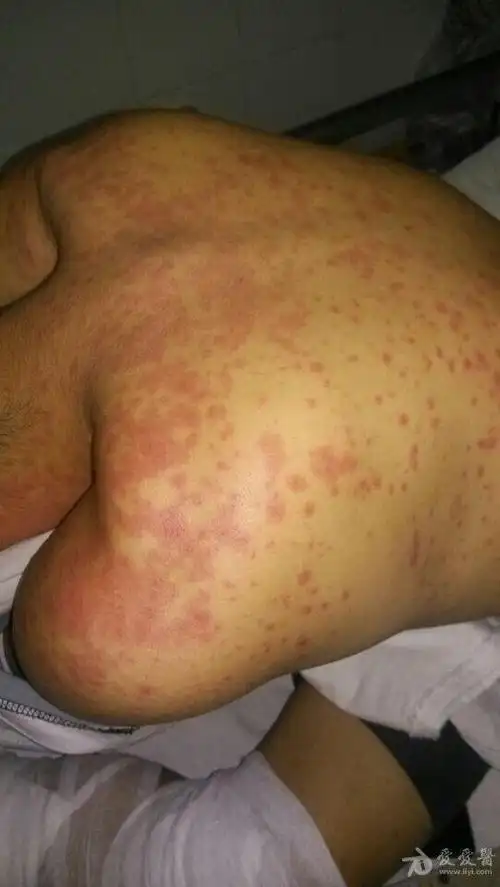 请问输参麦注射液过敏起皮疹怎么处理几天才能见效