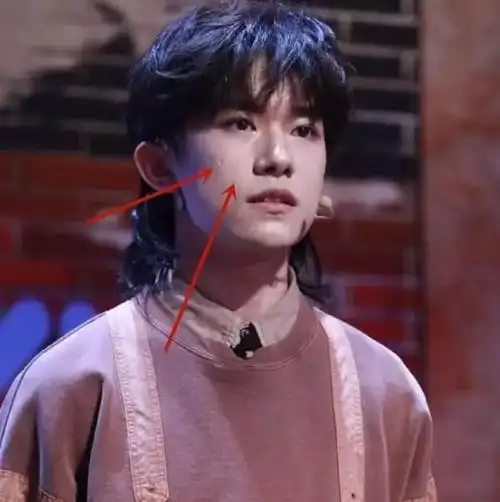 易烊千玺颜值崩塌生图一脸痘印让人意外千纸鹤这叫青春期