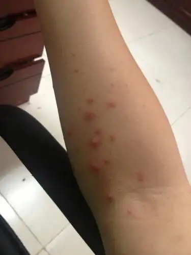 人在苏州,最近天气有点热,身上起了好多这种红疹子.这是怎么回事?