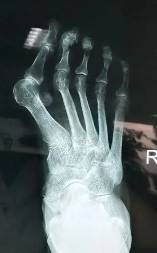 大脚骨,踇外翻畸形 - 好大夫在线