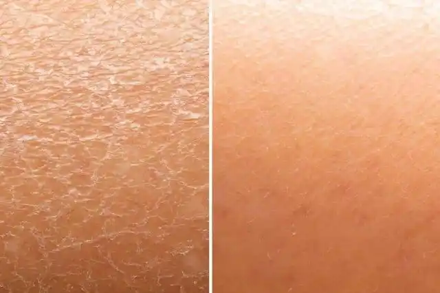 一入冬皮肤就干燥开裂,平时要注意细节,保持皮肤水嫩光滑不开裂