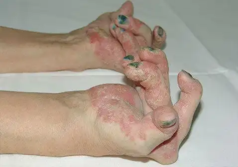 牛皮肤癣的症状图片