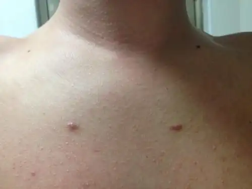 胸口长了一些小红点点长的是什么呀?