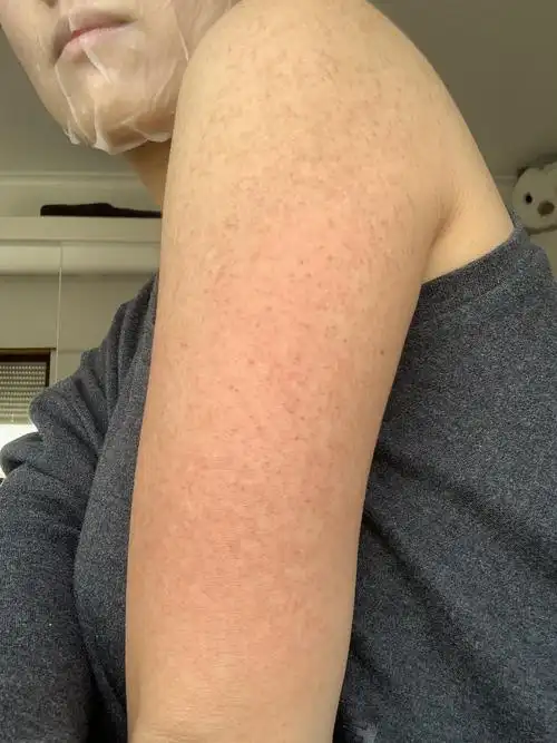 开个贴记录海藻矽针抗鸡皮过程 (姐妹们!我太感动了! .