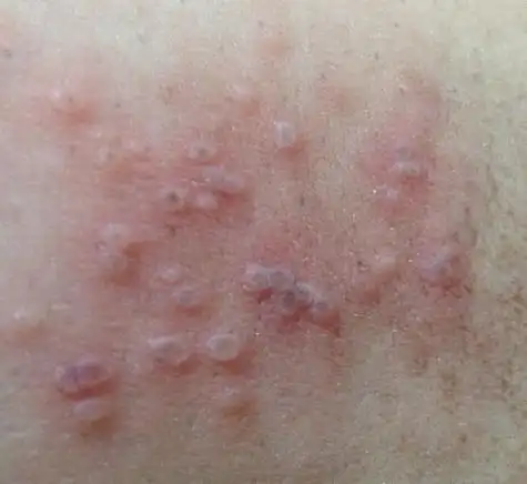 腋窝下长出小红点小水泡.很疼很痒,如图.