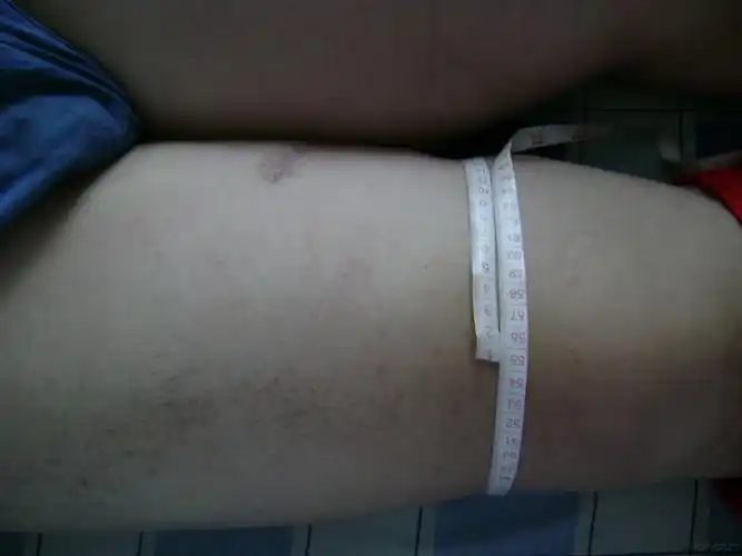 大家谁见过橡皮腿丝虫病这个像不像我没见过