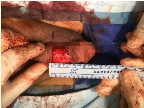 隐匿型阴茎合并包茎的患者看过来 - 好大夫在线