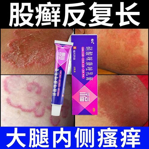 硝酸咪康唑乳膏 股癣专用药膏 股癣膏大腿内侧阴囊私处瘙痒变黑体癣