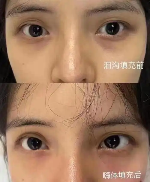 只有自己亲身体会才知道的嗨体熊猫针