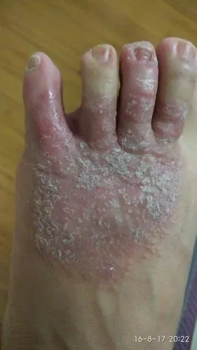 脚面湿疹
