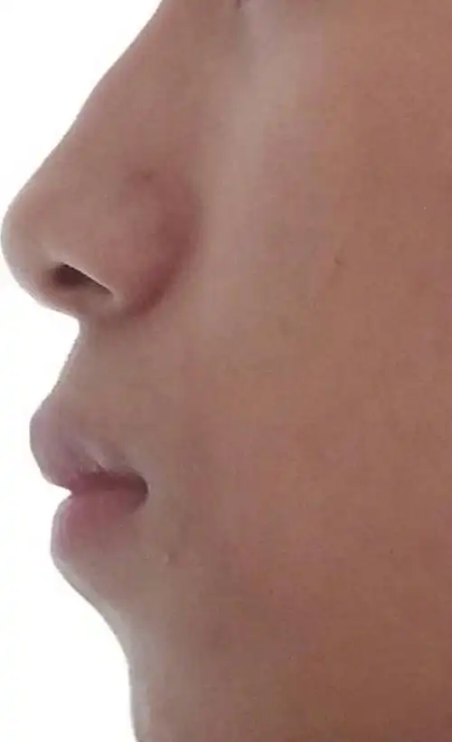 嘴巴突出怎么办啊,侧脸很难看 法令纹也很明显,像猴子的嘴一样,该