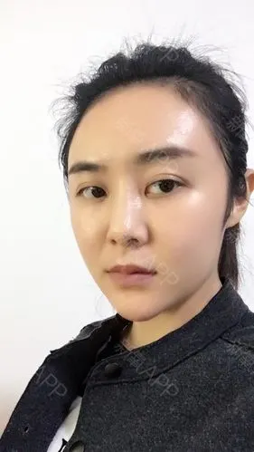 自体脂肪丰额头好不好_效果图_氧气_bbjye1305自体脂肪丰额头术后第16