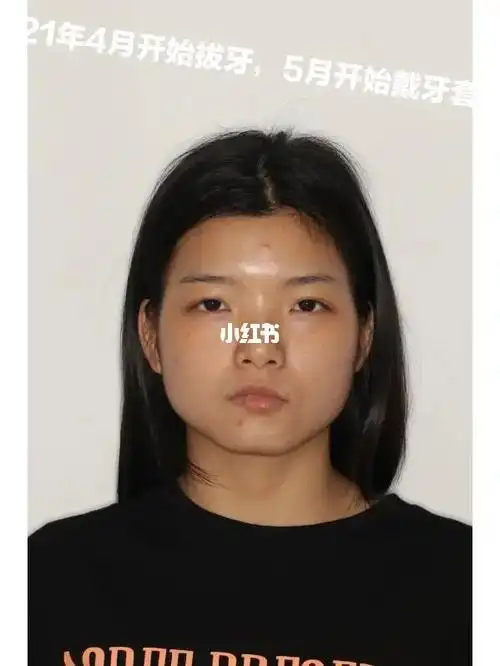 24岁广东女孩戴牙套一年零四个月变化