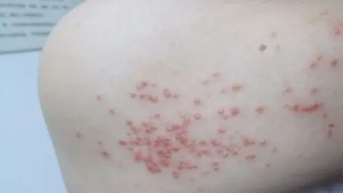 疥疮结节图片 (7)