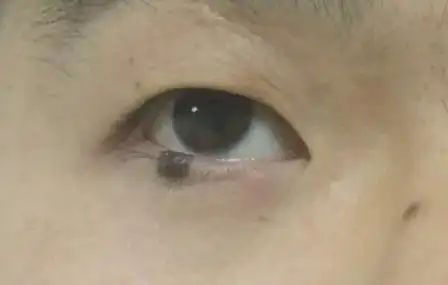 眼睑色素痣,眼睑肿物术前术后对比图 - 好大夫在线