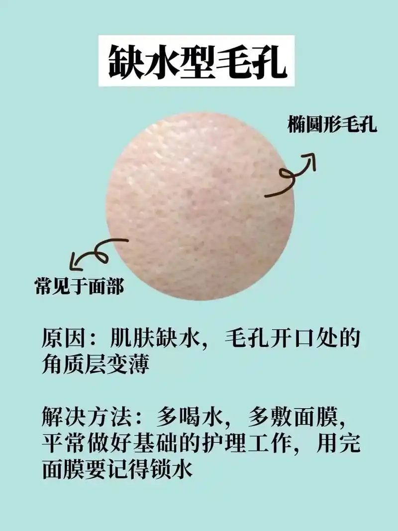 四种毛孔粗大类型