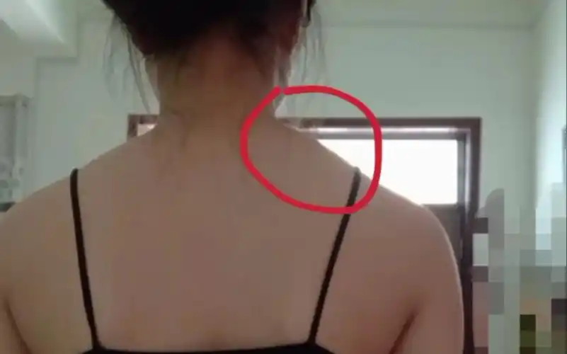 这个是什么啊 斜方肌 富贵包 溜肩?