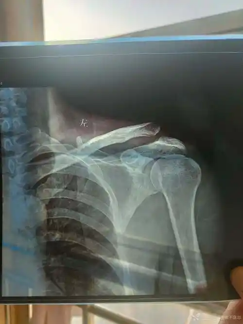 常规肩锁关节脱位锁骨钩没啥技巧