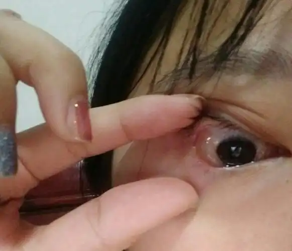 帮我看看我眼睛里这个白色大泡是什么 揉出来的