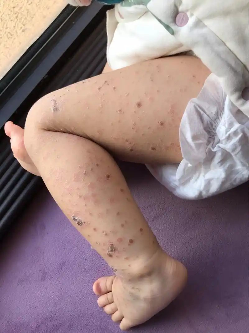 14个宝宝感染手足口第8天 首先非常感谢宝妈们对我家宝宝的关心75