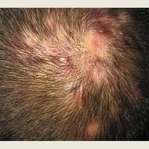 头部有毛囊炎用什么洗发水?_细胞_头皮_皮肤