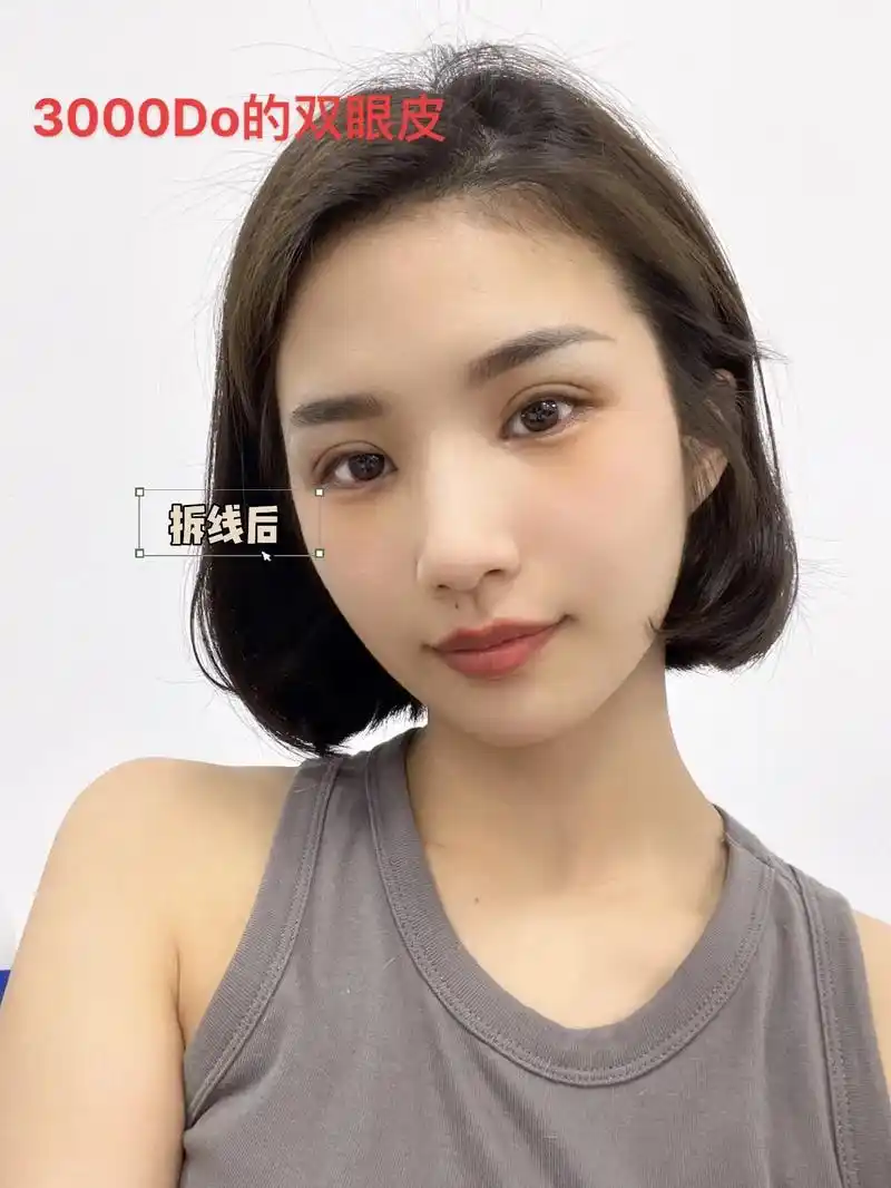 3000块的全切双眼皮