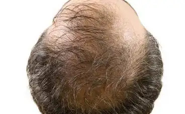 原创脱发迅速蔓延到90后这么做避免脱发