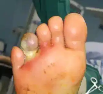 小小石子割破脚,竟可能要截肢?这个细节千万别忽略