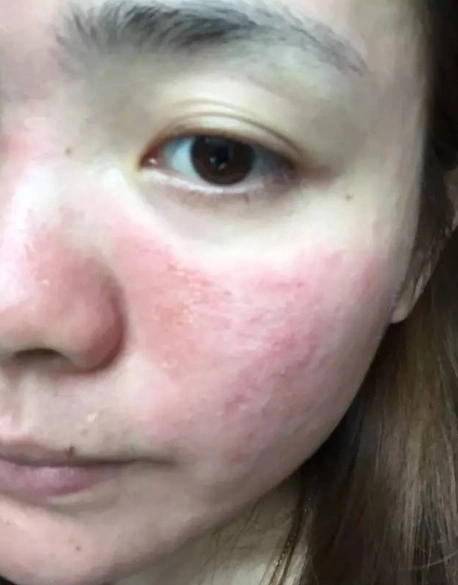 皮肤为什么反复过敏?过敏了怎么办?