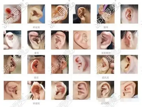一个正常的耳朵形态是结构齐全,形状规整的,如果耳朵缺了这两部分的