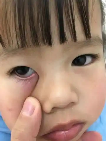 求助!宝宝眼睛这是怎麼了