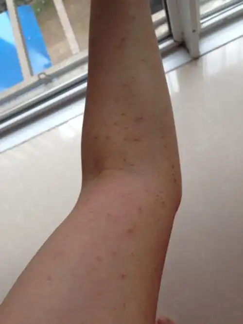 螨虫过敏症状图片大全